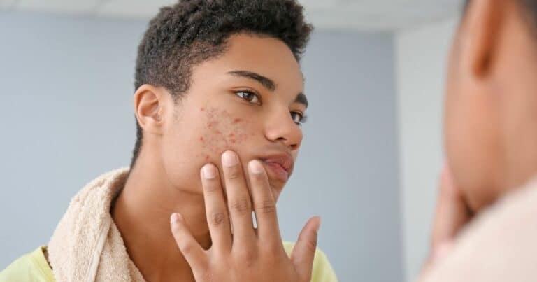 Teenage skin care